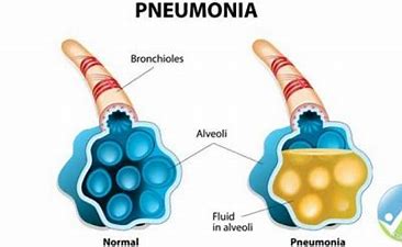 lung pneumonia